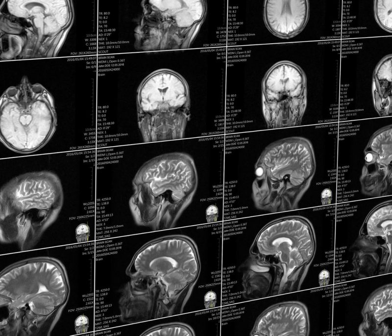 JAMA'da yayınlanan yeni çalışmada, henüz belirlenmemiş bir olguya maruz kaldıktan sonra klinik olarak değerlendirilen 40 kişide beyin fonksiyonunun üç farklı yönüne bakmak için beyin taramalarını kullanıldı. (Kaynak: Deposit Photos)