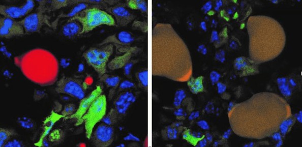 Bilim İnsanları Yayılmalarını Durdurmak için Meme Kanseri Hücrelerini Yağa Dönüştürdü